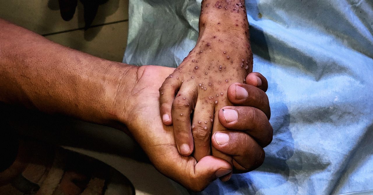 Os graves efeitos a longo prazo da crise de desnutrição de Gaza