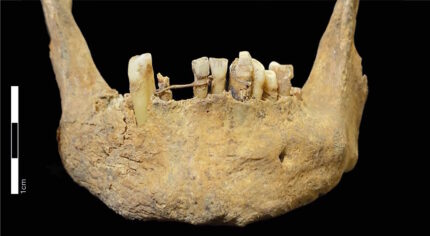 Exemplo mais antigo de odontologia restauradora na Escócia encontrado em osso de igreja paroquial – The History Blog
