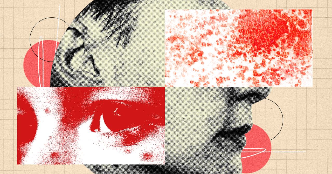 Você deveria estar mais assustado com herpes zoster