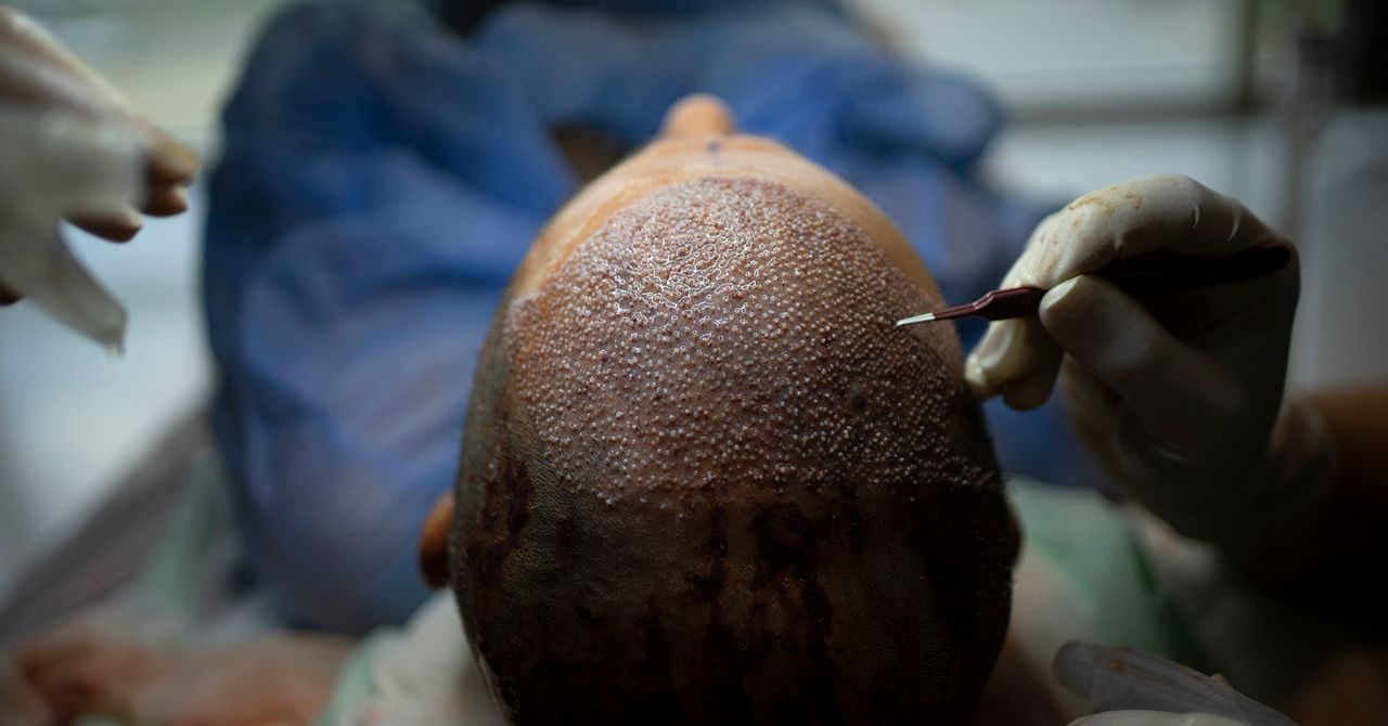 Como a Turquia invadiu a indústria de transplante capilar